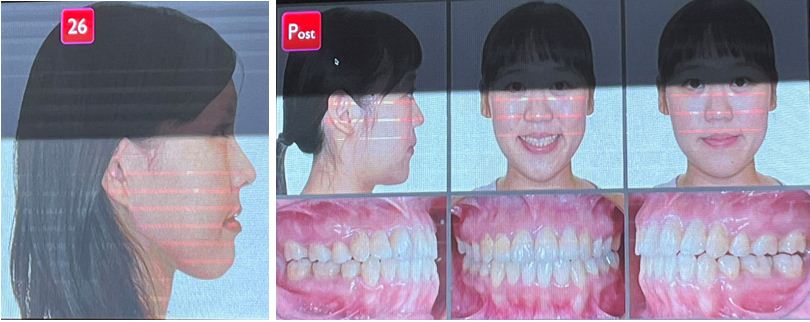 Hình ảnh bệnh nhân trước và sau điều trị